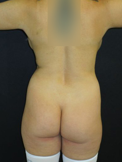 Liposuction Before & After Patient #4421