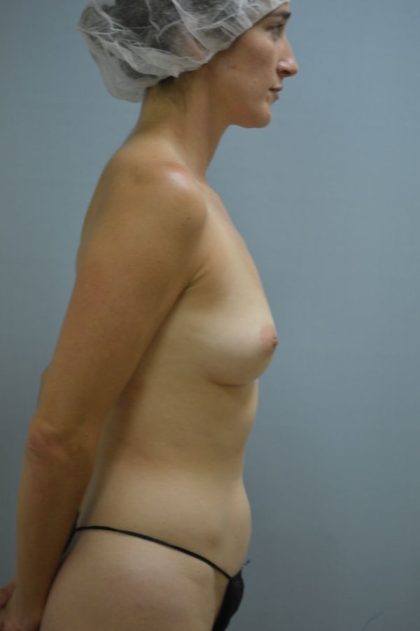 Fat Transfer Before & After Patient #4426