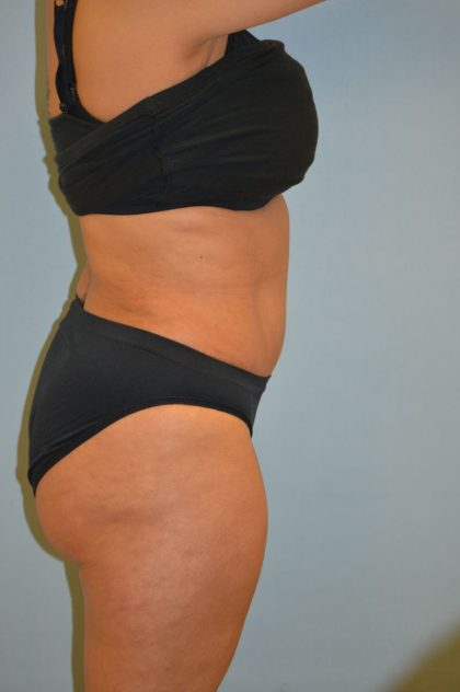 Tummy Tuck Before & After Patient #4443