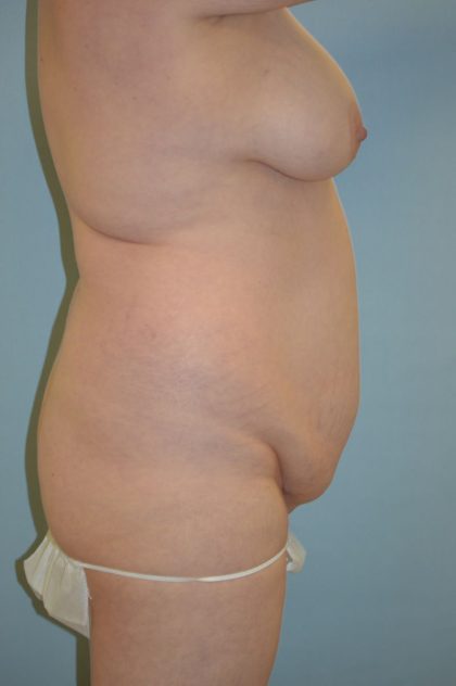 Tummy Tuck Before & After Patient #4444