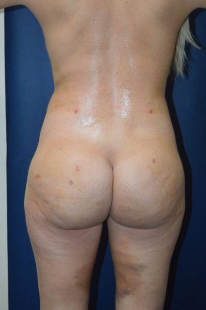 Liposuction Before & After Patient #4420