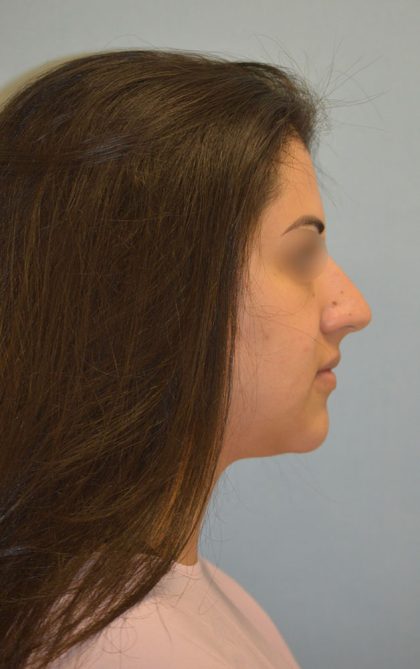 Rhinoplasty Before & After Patient #4570