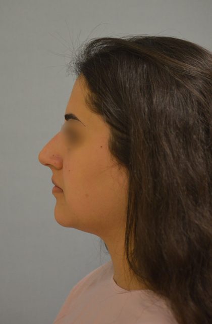 Rhinoplasty Before & After Patient #4570