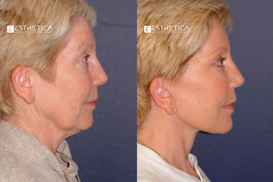 before-after-Neck Lift Case #2897-feat