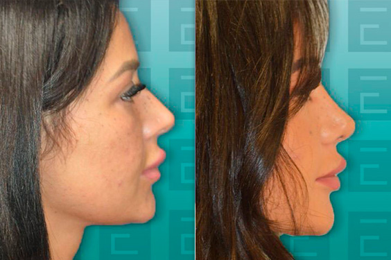 before-after-Rhinoplasty Case #4181-feat