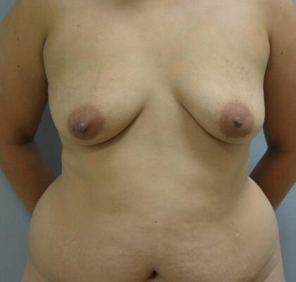 3_After_TT_Muscle_Plication_lipo_and_Breast_Aug_FInal__1-420x571