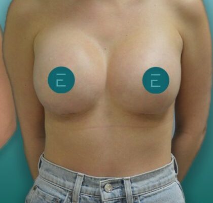 breast1-1-420x485