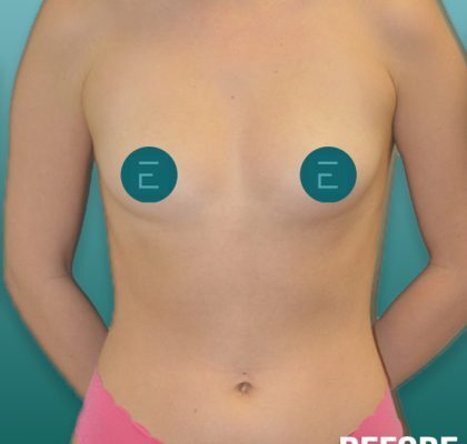 breast1-copy-1-420x464