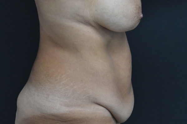 Liposuction-of-the-abdomen-1-before