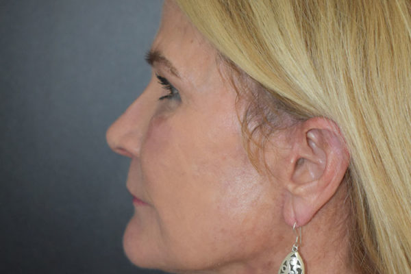 Lower-facelift-1-after-3